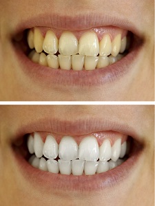 Brighten your smile with Zoom teeth whitening procedure and take-home whitening trays from Parkside Dental in Dubbo.