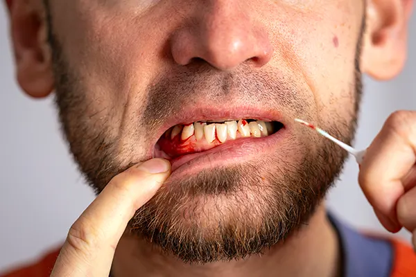 Bleeding Gums