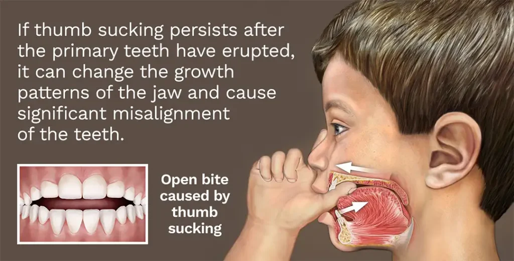 Thumbsucking Infographic