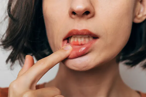 Periodontal Disease